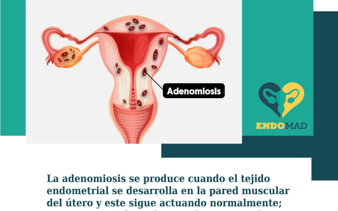 Adenomiosis: cuando la menstruación se convierte en un infierno