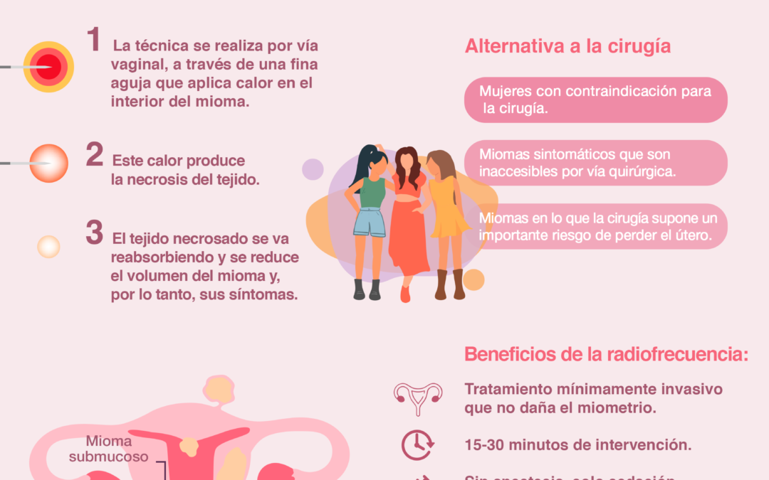 La ablación de los miomas es una alternativa a la cirugía para conservar el útero